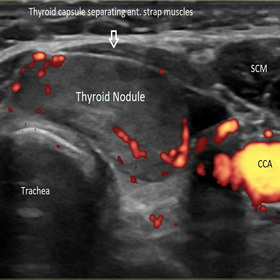 Radiofrequency ablation offers a nonsurgical treatment for thyroid nodules