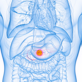 Presurgical radiation may curb pancreatic cancer recurrence