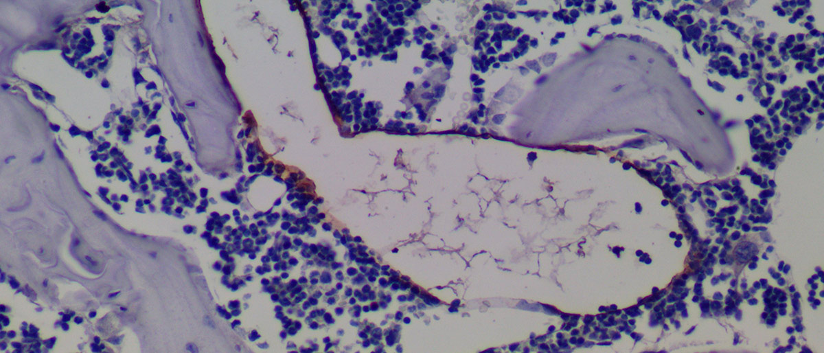 Photo of a microscopic view of purple spots around a larrge, lined mass