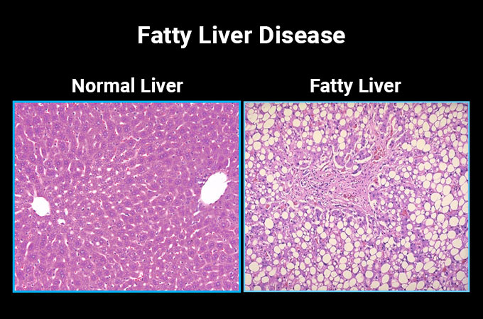 Slides of fatty liver disease