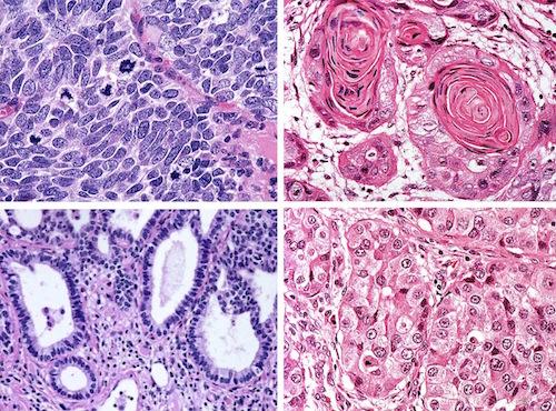 The UT SPORE in Lung Cancer studies all major forms of the disease, including (clockwise, from top left) small cell carcinoma and squamous cell carcinoma, heavily associated with smoking, and large cell carcinoma and adenocarcinoma, less strongly associated with smoking.