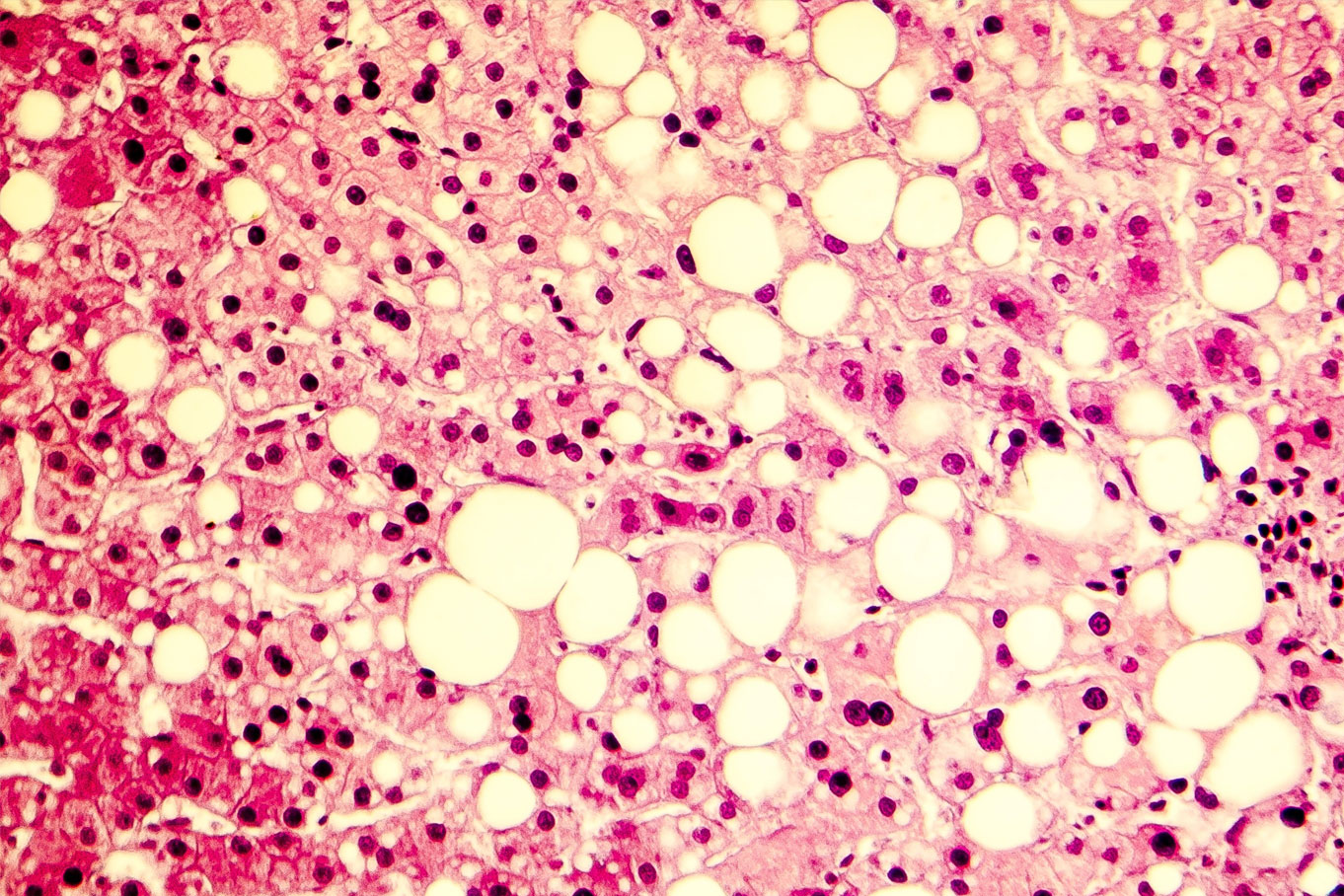 Fatty liver tissue Fatty liver tissue