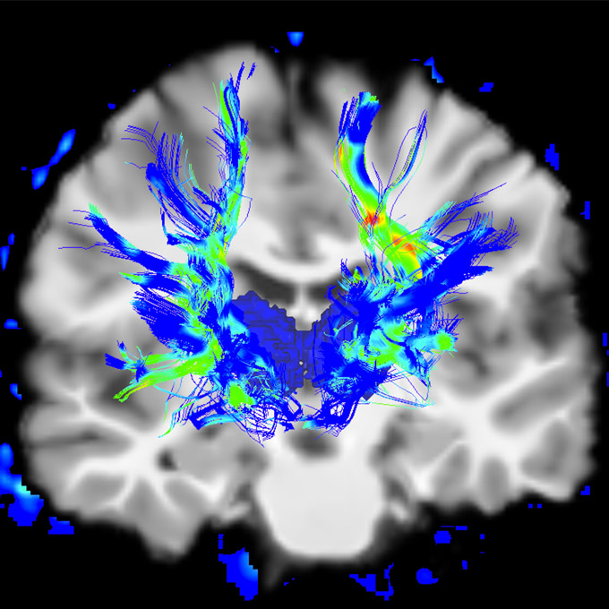 The fibers of the motor system in a human brain with Parkinson’s disease 