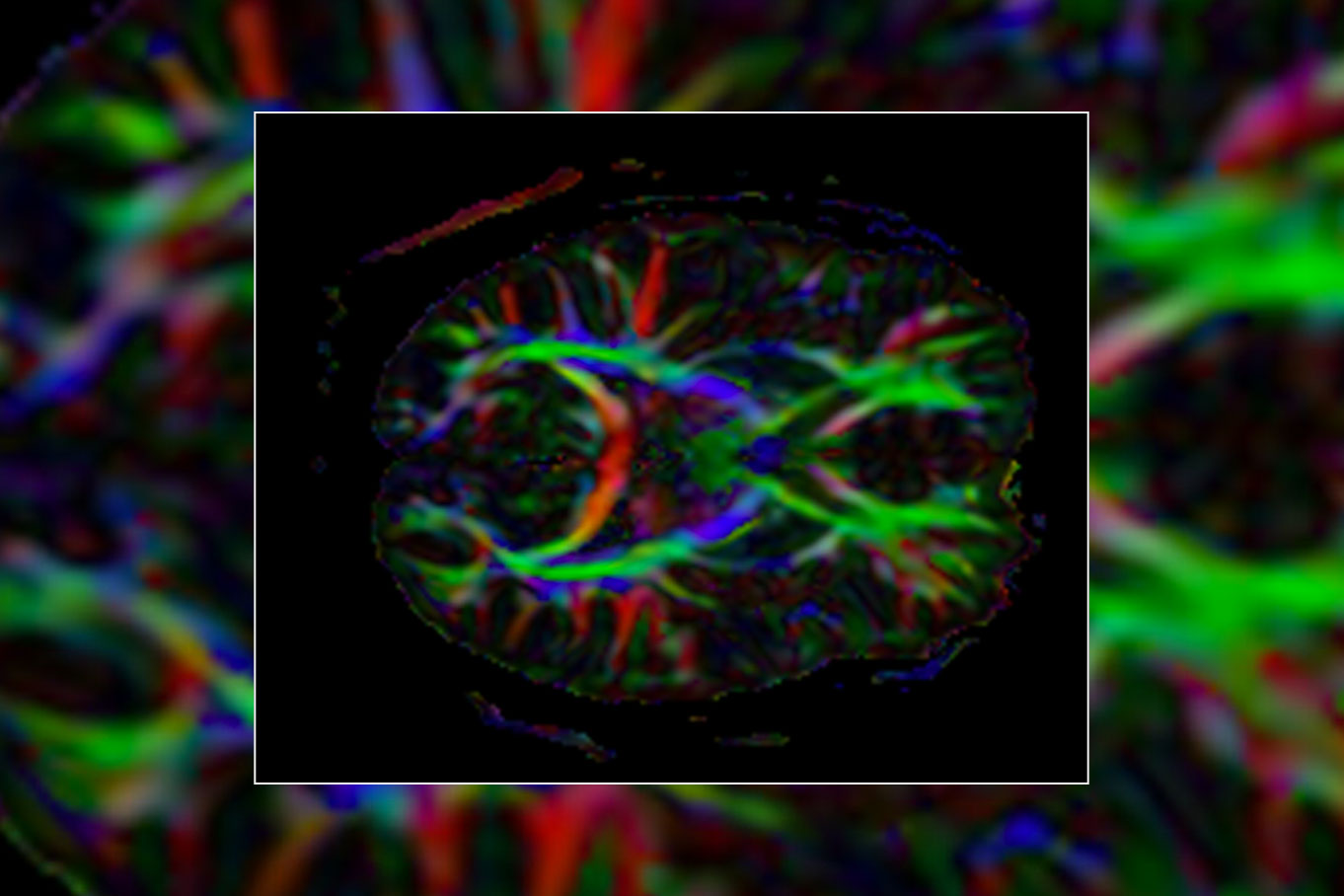 MRI image of the human brain with various colors representing different neuron pathways