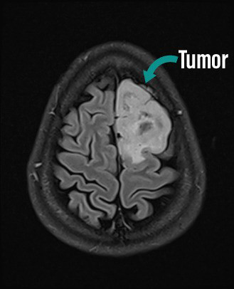 Image of brain showing large white spot