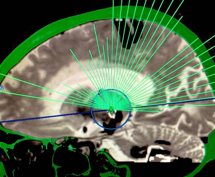 Diagram of brain with green lines