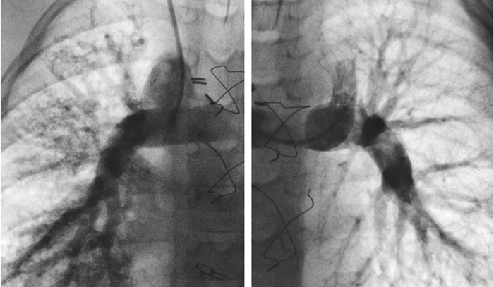 Image of lungs in black and white