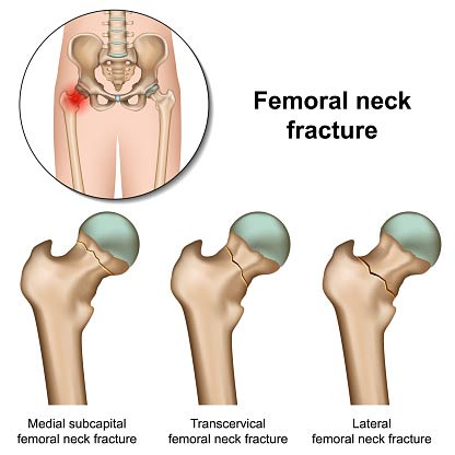 Diagram showing three types of femoral neck fractures