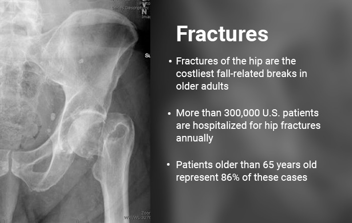X-ray of hip fracture with info on hip fractures