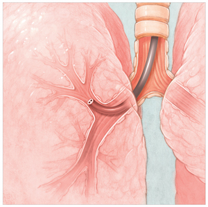 Photo of using scope in lungs