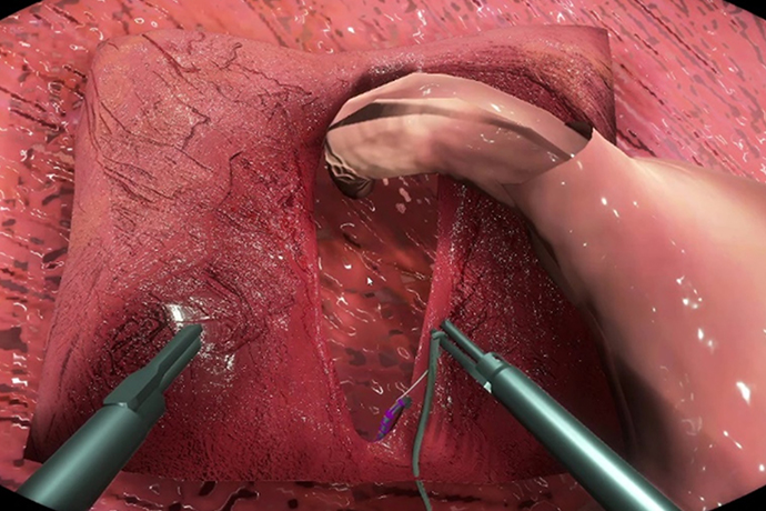 sVR surgical training image of laparoscopic hernia procedure