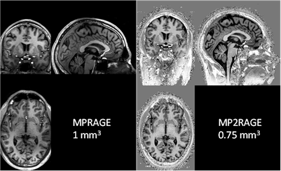 MP2RAGE scan images compare isotropic resolutions side by side