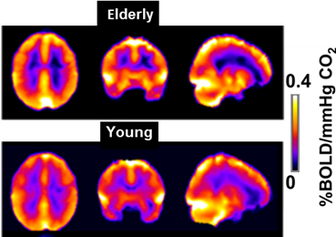 cerebrovascular reacitivty mapping image