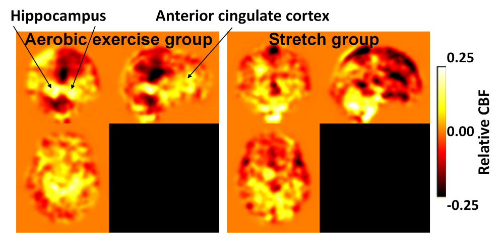 scan showing cerebral blood flow