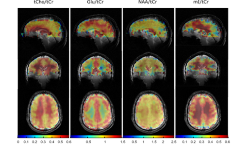 metabolic brain imaging scan