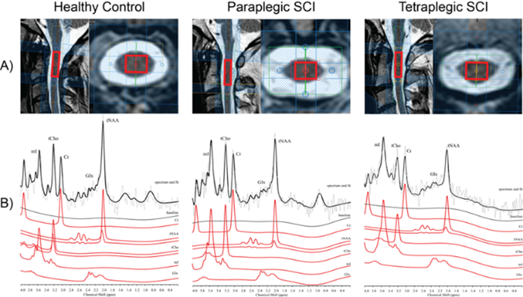 metabolic spinal cord imaging scan