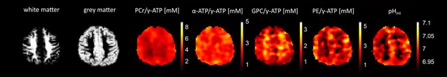 31P MRS and MRSI imaging scan at AIRC