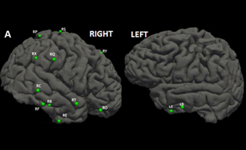 refractory-epilepsy-surgical-outcomes