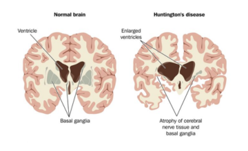 Huntington's Disease