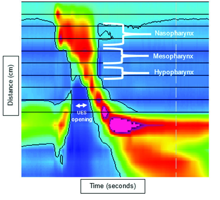 An example of high-resolution pharyngeal manometry