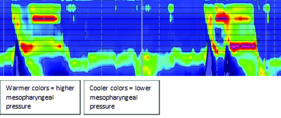 An additional example of high-resolution pharyngeal manometry