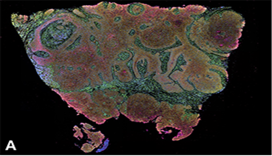 Head and neck squamous cell carcinoma