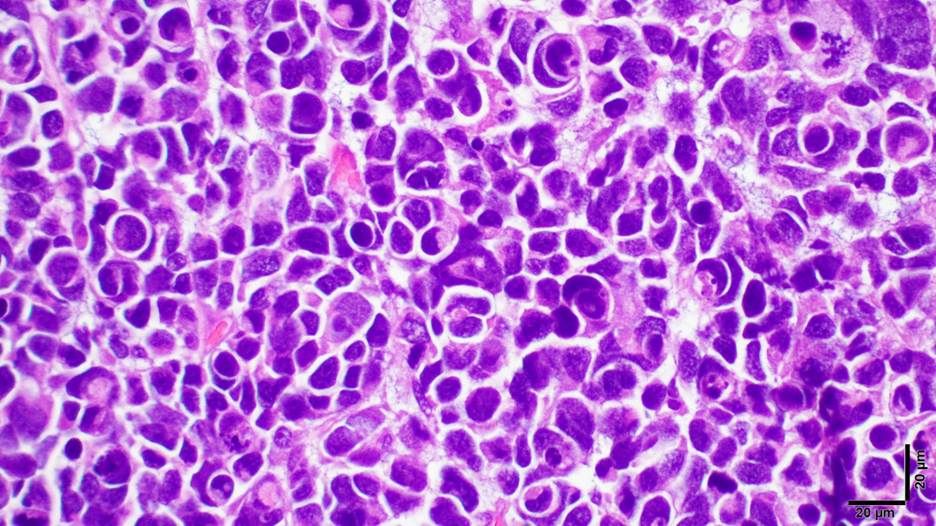 A photomicrograph of a large cell/anaplastic pediatric medulloblastoma