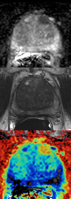 Image of prostate cancer. 