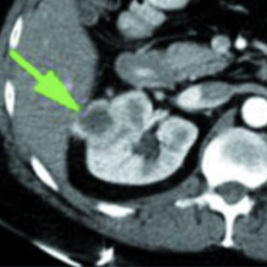 Cells with a green arrow pointing to a dark spot