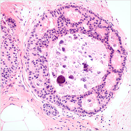 Breast cancer. Breast cancer image