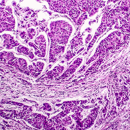 Metastasis Image