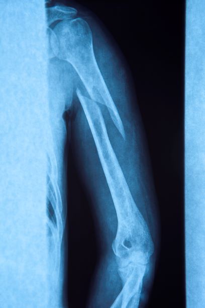 X-ray of Broken Arm