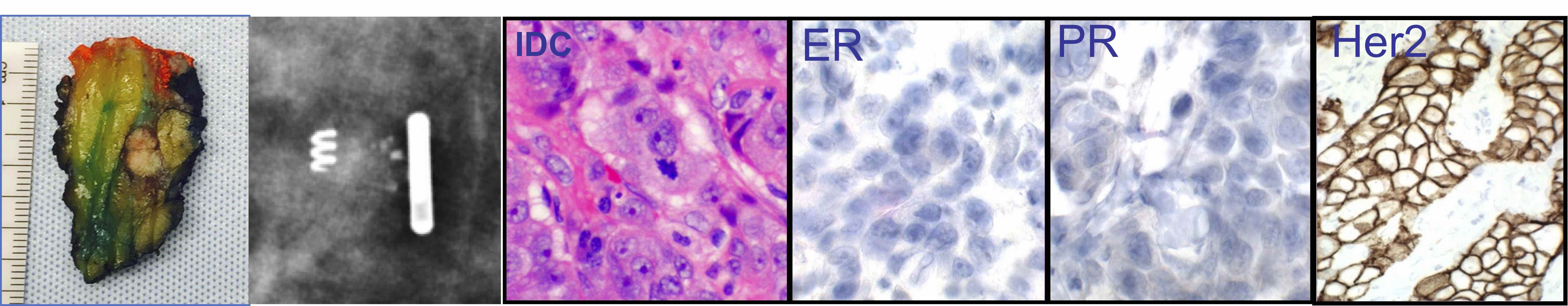 Breast Gross, Histology, and IHC