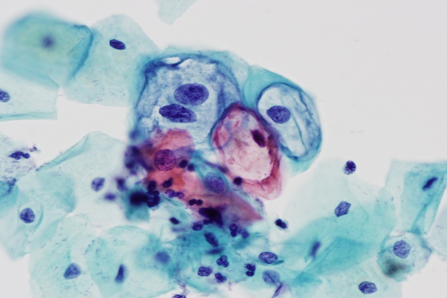 LSIL Pap Smear 40x