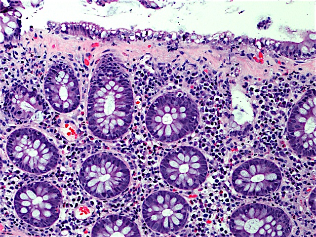 Collagenous Colitis