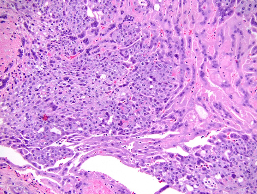 Trophoblastic Tumor