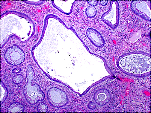 Juvenile Polyp