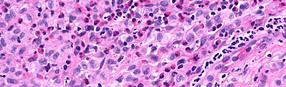 Anatomic Pathology Consultation - Langerhans Cell Histiocytosis