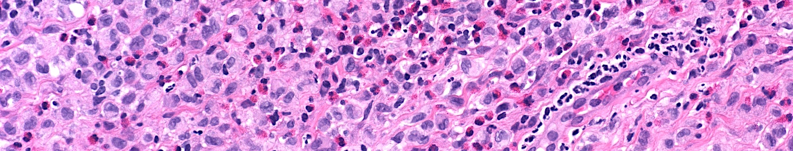 Langerhans Cell Histiocytosis