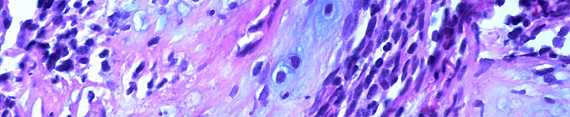 Mesenchymal Chondrosarcoma