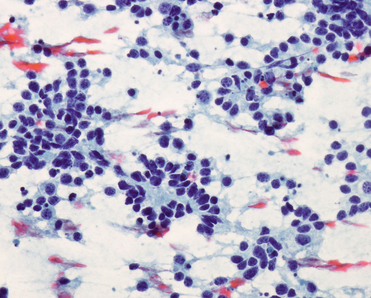 Neuroblastoma, Papanicolaou Stain, 20X