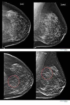 3-D Mammogram