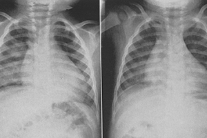 Bonte and Reynolds Cineangiocardiograph Study Two chest X-ray images