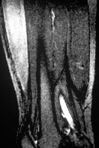 MRI of a Human Leg MRI image of thigh muscles