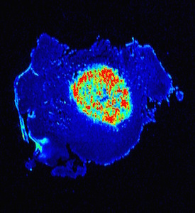 image shows cancer tissue at the microscopic level