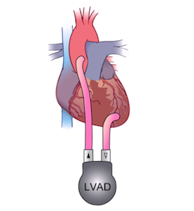   A left ventricular assist device