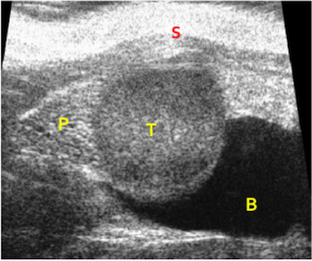 Orthoptic Prostate