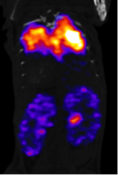 Renal TC-MAG3