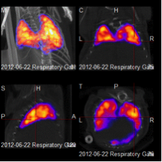 Respiratory Gating