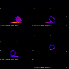 SPECT Cardiac Gating